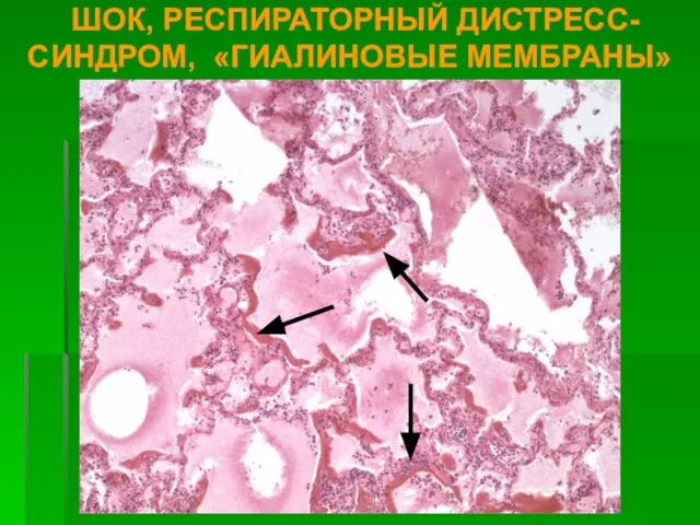 ШОК, РЕСПИРАТОРНЫЙ ДИСТРЕСС-СИНДРОМ, «ГИАЛИНОВЫЕ МЕМБРАНЫ»