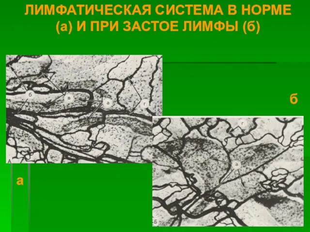 ЛИМФАТИЧЕСКАЯ СИСТЕМА В НОРМЕ (а) И ПРИ ЗАСТОЕ ЛИМФЫ (б) а б