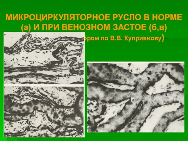 МИКРОЦИРКУЛЯТОРНОЕ РУСЛО В НОРМЕ (а) И ПРИ ВЕНОЗНОМ ЗАСТОЕ (б,в) (импрегнация серебром по В.В. Куприянову)