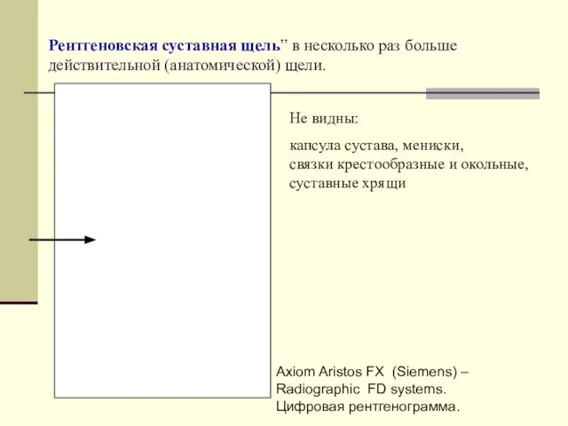 Рентгеновская суставная щель” в несколько раз больше действительной (анатомической) щели. Axiom Aristos