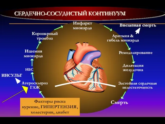 СЕРДЕЧНО-СОСУДИСТЫЙ КОНТИНУУМ Инфаркт миокарда Аритмия & гибель миокарда Ремоделирование Дилятация желудочка Застойная