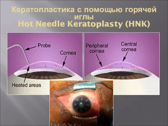 Кератопластика с помощью горячей иглы Hot Needle Keratoplasty (HNK)