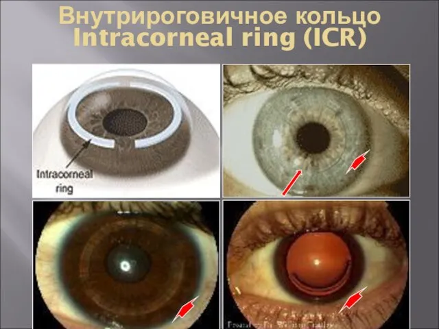 Внутрироговичное кольцо Intracorneal ring (ICR)