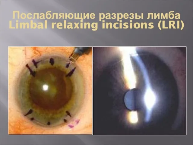 Послабляющие разрезы лимба Limbal relaxing incisions (LRI)