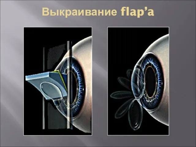 Выкраивание flap’a