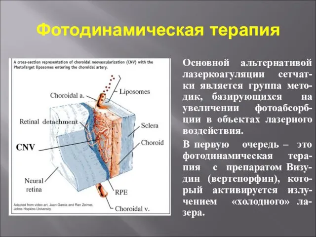 Фотодинамическая терапия Основной альтернативой лазеркоагуляции сетчат-ки является группа мето-дик, базирующихся на увеличении