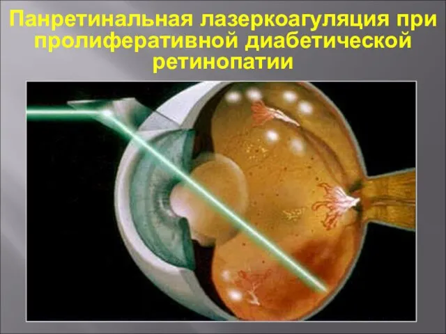 Панретинальная лазеркоагуляция при пролиферативной диабетической ретинопатии