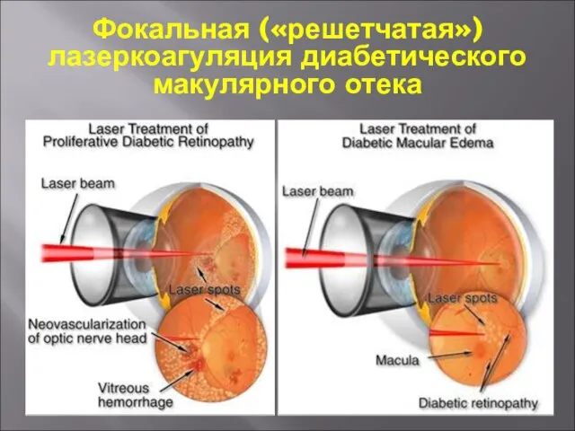 Фокальная («решетчатая») лазеркоагуляция диабетического макулярного отека