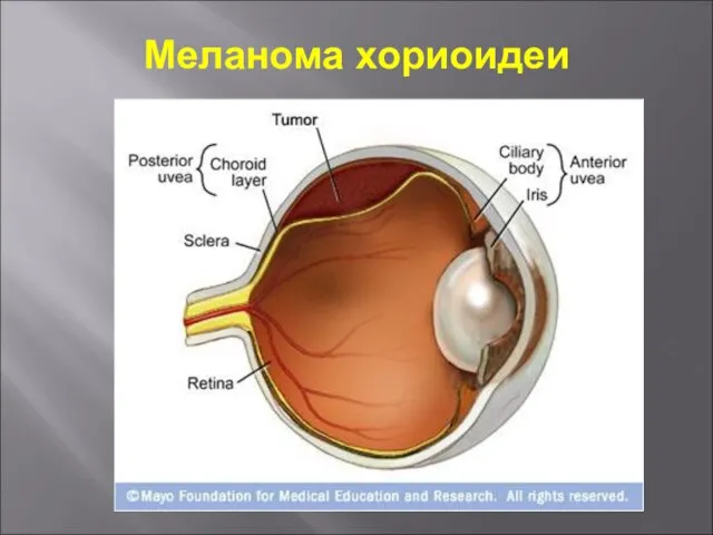 Меланома хориоидеи