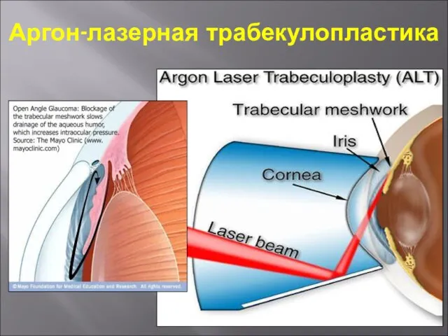 Аргон-лазерная трабекулопластика