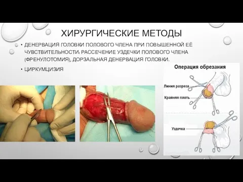 ХИРУРГИЧЕСКИЕ МЕТОДЫ ДЕНЕРВАЦИЯ ГОЛОВКИ ПОЛОВОГО ЧЛЕНА ПРИ ПОВЫШЕННОЙ ЕЁ ЧУВСТВИТЕЛЬНОСТИ: РАССЕЧЕНИЕ УЗДЕЧКИ