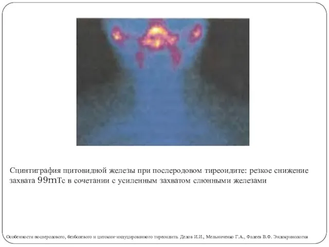 Сцинтиграфия щитовидной железы при послеродовом тиреоидите: резкое снижение захвата 99mТс в сочетании