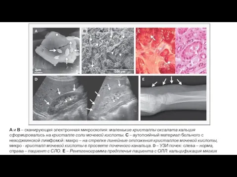 А и В – сканирующая электронная микроскопия: маленькие кристаллы оксалата кальция сформировались