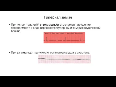 Гиперкалиемия При концентрации К+ 8–10 ммоль/л отмечается нарушение проводимости в виде атриовентрикулярной