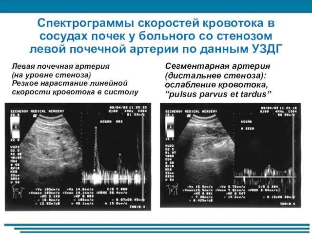 Спектрограммы скоростей кровотока в сосудах почек у больного со стенозом левой почечной