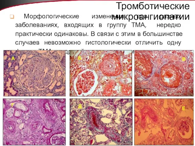 Тромботические микроангиопатии Морфологические изменения при разных заболеваниях, входящих в группу ТМА, нередко