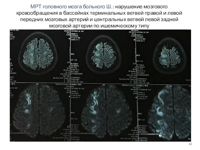 МРТ головного мозга больного Ш.: нарушение мозгового кровообращения в бассейнах терминальных ветвей