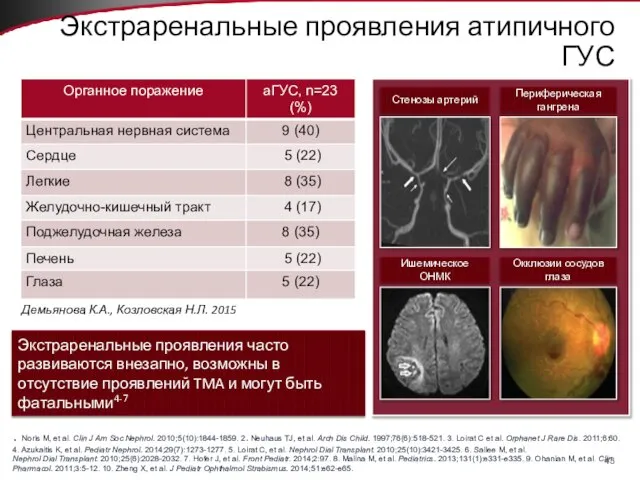 Экстраренальные проявления атипичного ГУС Демьянова К.А., Козловская Н.Л. 2015 Экстраренальные проявления часто