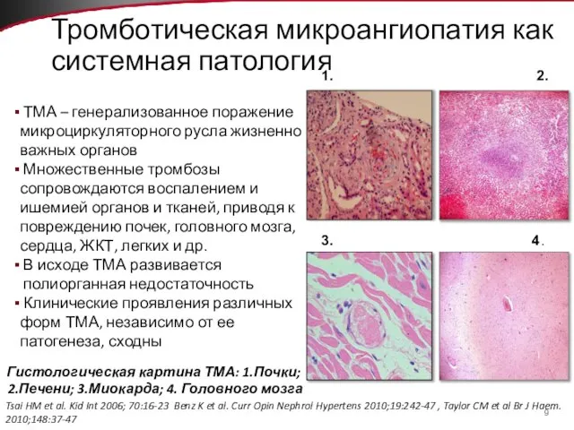 Тромботическая микроангиопатия как системная патология ТМА – генерализованное поражение микроциркуляторного русла жизненно