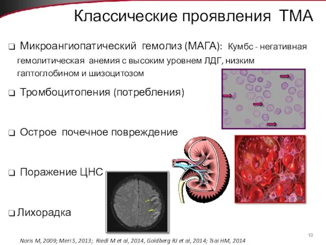 Классические проявления ТМА Микроангиопатический гемолиз (МАГА): Кумбс - негативная гемолитическая анемия с