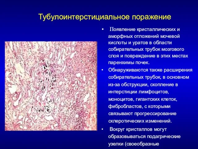 Тубулоинтерстициальное поражение Появление кристаллических и аморфных отложений мочевой кислоты и уратов в