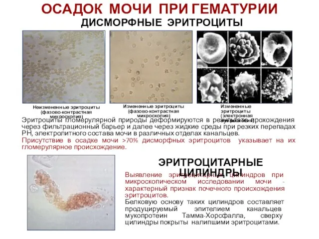 ОСАДОК МОЧИ ПРИ ГЕМАТУРИИ