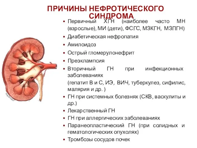 ПРИЧИНЫ НЕФРОТИЧЕСКОГО СИНДРОМА Первичный ХГН (наиболее часто МН (взрослые), МИ (дети), ФСГС,