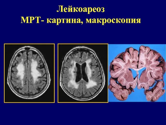 Лейкоареоз МРТ- картина, макроскопия