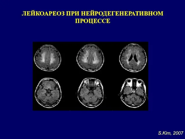 ЛЕЙКОАРЕОЗ ПРИ НЕЙРОДЕГЕНЕРАТИВНОМ ПРОЦЕССЕ S.Kim, 2007