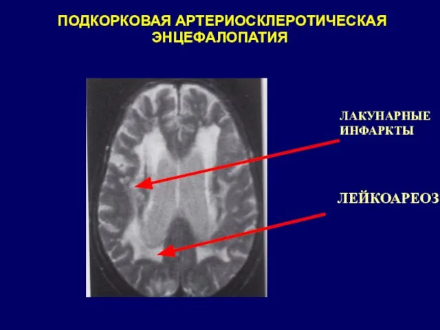 ПОДКОРКОВАЯ АРТЕРИОСКЛЕРОТИЧЕСКАЯ ЭНЦЕФАЛОПАТИЯ ЛЕЙКОАРЕОЗ ЛАКУНАРНЫЕ ИНФАРКТЫ