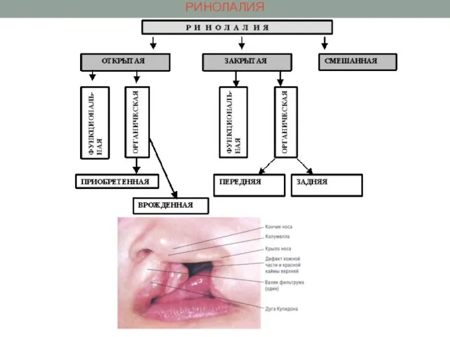 РИНОЛАЛИЯ