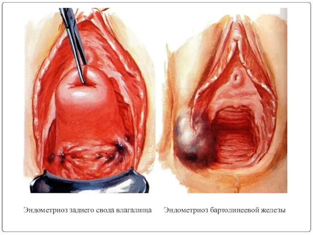 Эндометриоз заднего свода влагалища Эндометриоз бартолинеевой железы
