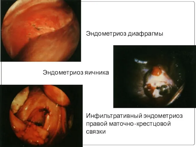 Эндометриоз диафрагмы Эндометриоз яичника Инфильтративный эндометриоз правой маточно-крестцовой связки