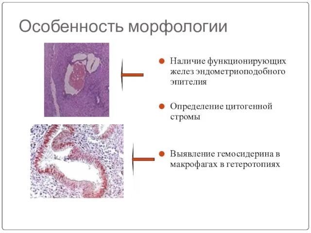 Особенность морфологии Наличие функционирующих желез эндометриоподобного эпителия Определение цитогенной стромы Выявление гемосидерина в макрофагах в гетеротопиях