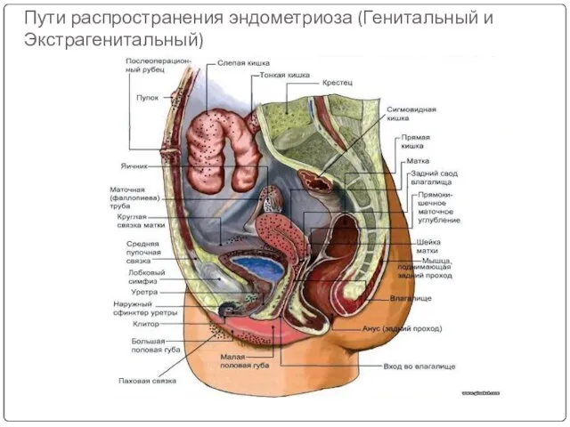 Пути распространения эндометриоза (Генитальный и Экстрагенитальный)