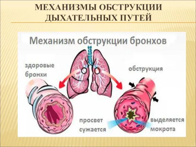 МЕХАНИЗМЫ ОБСТРУКЦИИ ДЫХАТЕЛЬНЫХ ПУТЕЙ