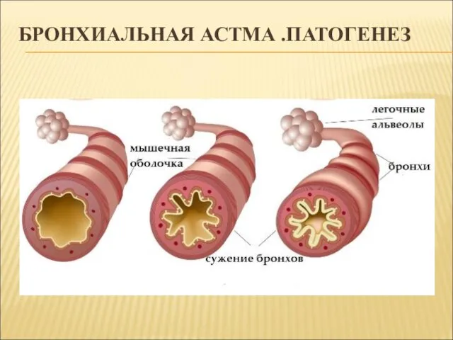 БРОНХИАЛЬНАЯ АСТМА .ПАТОГЕНЕЗ