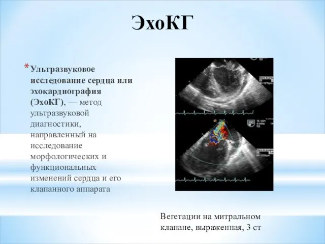 ЭхоКГ Ультразвуковое исследование сердца или эхокардиография (ЭхоКГ), — метод ультразвуковой диагностики, направленный