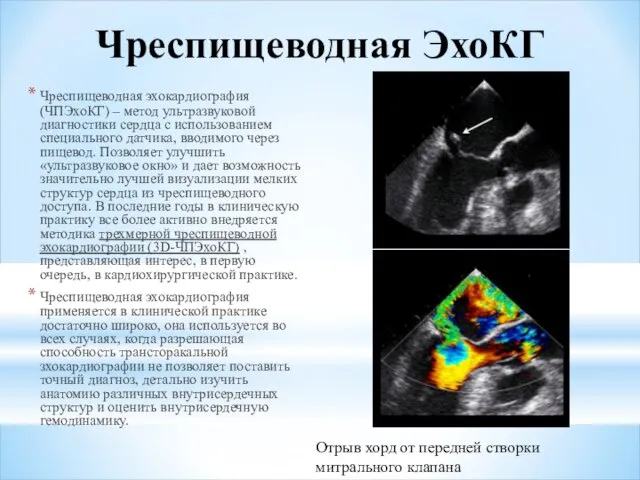 Чреспищеводная ЭхоКГ Чреспищеводная эхокардиография (ЧПЭхоКГ) – метод ультразвуковой диагностики сердца с использованием