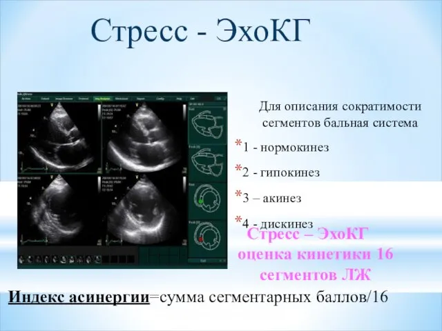 Для описания сократимости сегментов бальная система 1 - нормокинез 2 - гипокинез