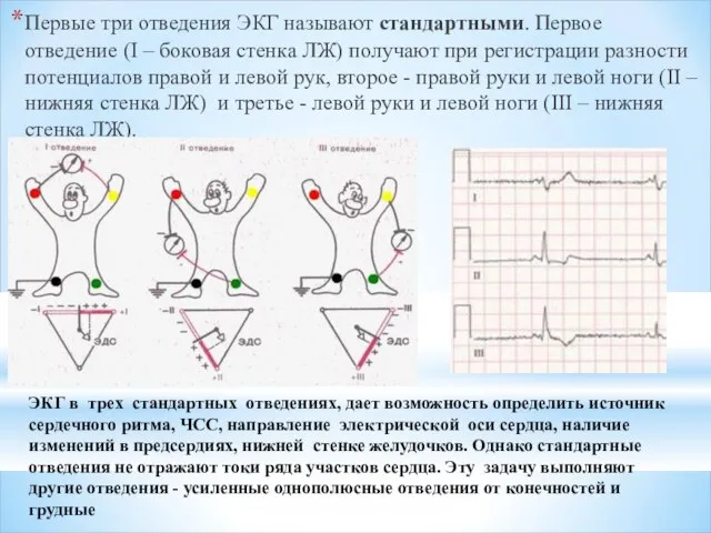 Первые три отведения ЭКГ называют стандартными. Первое отведение (I – боковая стенка