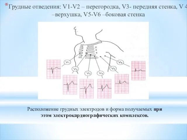 Грудные отведения: V1-V2 – перегородка, V3- передняя стенка, V 4 –верхушка, V5-V6