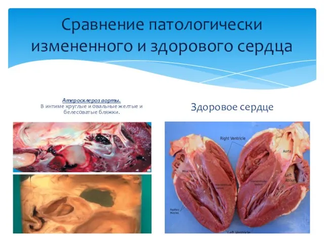 Сравнение патологически измененного и здорового сердца Атеросклероз аорты. В интиме круглые и