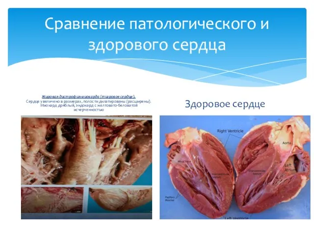 Сравнение патологического и здорового сердца Жировая дистрофия миокарда (тигровое сердце). Сердце увеличено