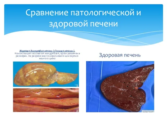 Сравнение патологической и здоровой печени Жировая дистрофия печени («Гусиная печень»). Консистенция тестоватая