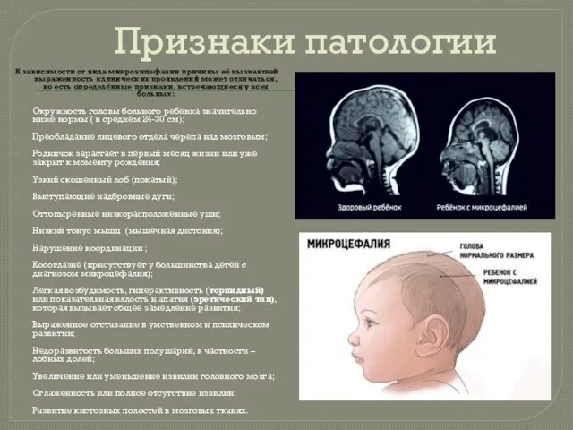 Признаки патологии В зависимости от вида микроэнцефалии причины её вызвавшей выраженность клинических