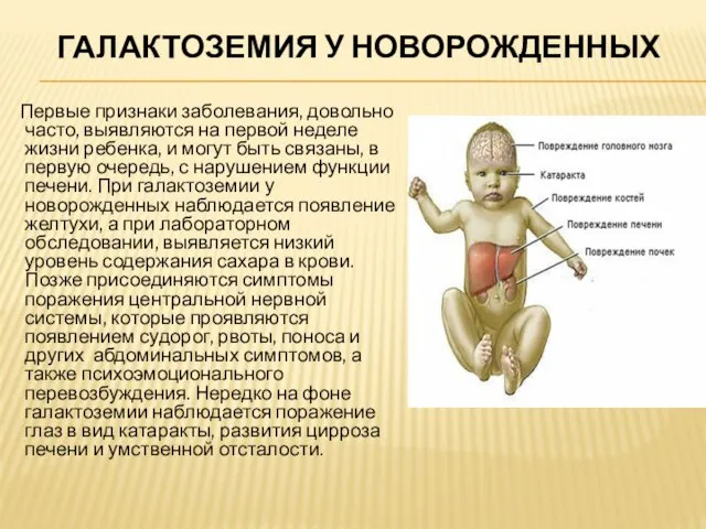 ГАЛАКТОЗЕМИЯ У НОВОРОЖДЕННЫХ Первые признаки заболевания, довольно часто, выявляются на первой неделе