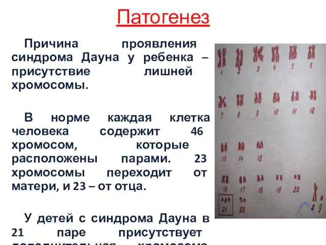 Патогенез Причина проявления синдрома Дауна у ребенка – присутствие лишней хромосомы. В