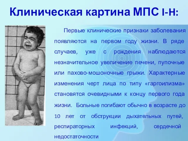 Клиническая картина МПС I-H: Первые клинические признаки заболевания появляются на первом году