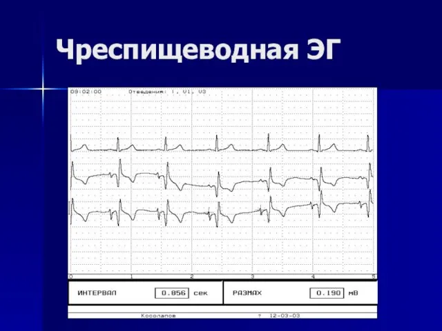 Чреспищеводная ЭГ